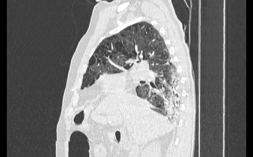 Cavitating bronchogenic carcinoma (Radiopaedia 44489-48162 Sagittal lung window 18).jpg