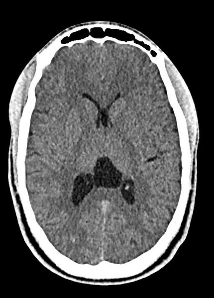 File:Cavum septum pellucidum and cavum vergae (Radiopaedia 77797-90060 Axial Brain Window 55).jpg