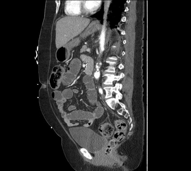 File:Celiac artery severe stenosis and dissection (Radiopaedia 44128-47842 A 17).jpg