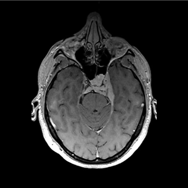 File:Central base of skull meningioma (Radiopaedia 53531-59549 Axial T1 C+ 14).jpg