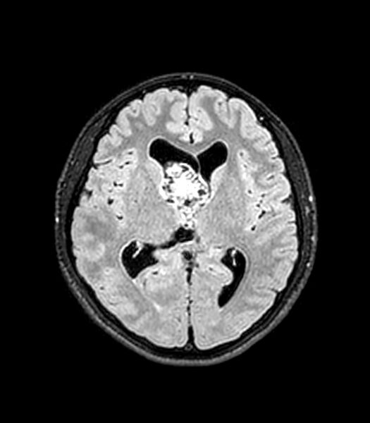 File:Central neurocytoma (Radiopaedia 79320-92380 Axial FLAIR 154).jpg
