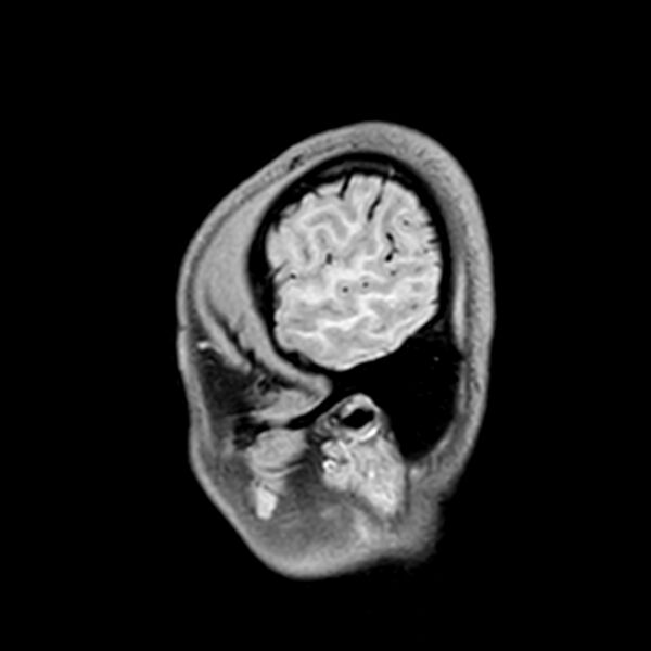 File:Central neurocytoma (Radiopaedia 79320-92380 Sagittal T1 234).jpg