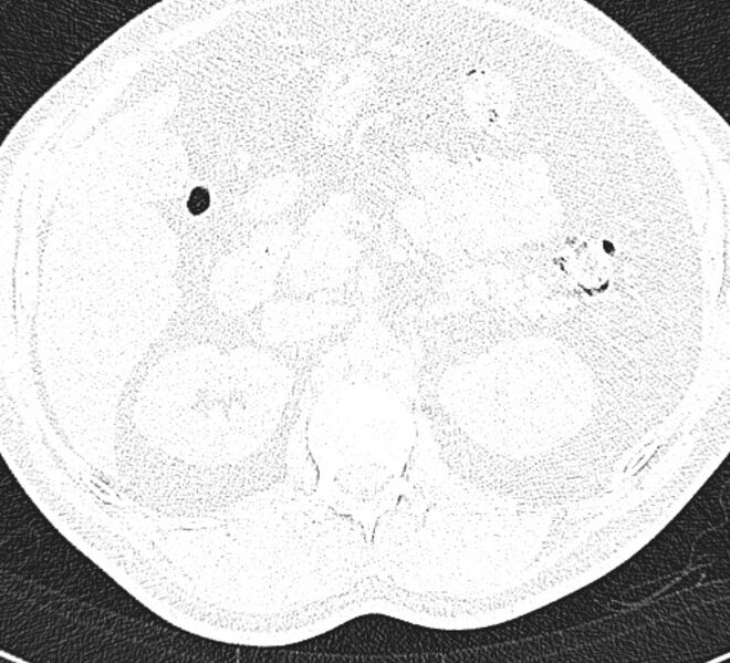 File:Centrilobular pulmonary emphysema (Radiopaedia 26808-26971 Axial lung window 44).jpg