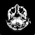 Cerebellar abscess secondary to mastoiditis (Radiopaedia 26284-26412 Axial non-contrast 7).jpg