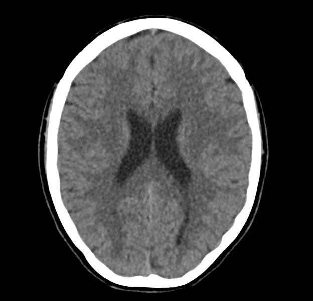 File:Cerebellar agenesis (Radiopaedia 30203-30817 Axial non-contrast 29).jpg