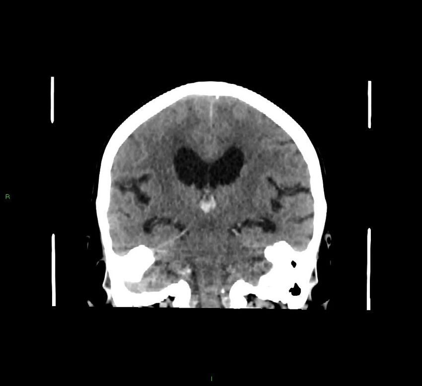 Cerebellar hemorrhage (Radiopaedia 58793-66027 Coronal non-contrast 33).jpg