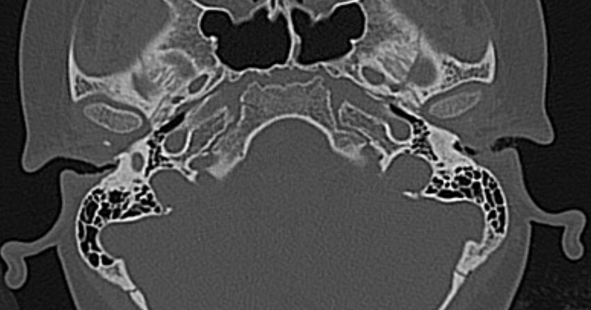 Cerebellopontine angle lipoma (Radiopaedia 57303-64242 Axial bone window 14).jpg