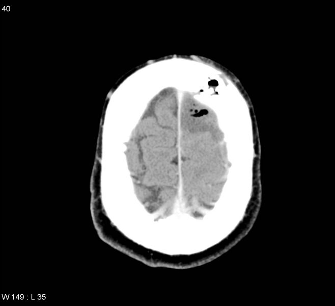 File:Cerebral abscess (Radiopaedia 5150-6933 Axial C+ delayed 9).jpg