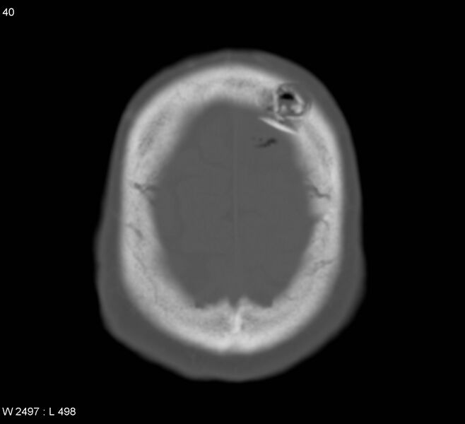 File:Cerebral abscess (Radiopaedia 5150-6933 Axial bone window 4).jpg