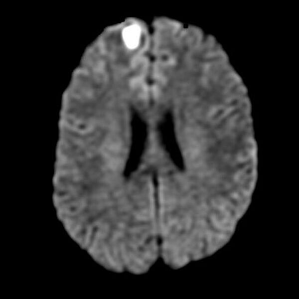 File:Cerebral abscess (Radiopaedia 9975-10538 Axial DWI 1).JPG