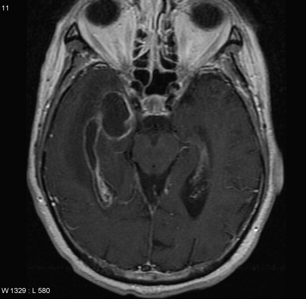 File:Cerebral abscess and ventriculitis (Radiopaedia 5024-6885 Axial T1 C+ 2).jpg
