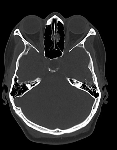 File:Cerebral abscesses (Radiopaedia 70458-80568 Axial bone window 20).jpg