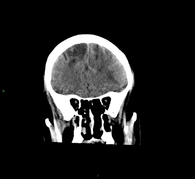 File:Cerebral amyloid angiopathy-associated lobar intracerebral hemorrhage (Radiopaedia 58529-65681 Coronal non-contrast 49).jpg