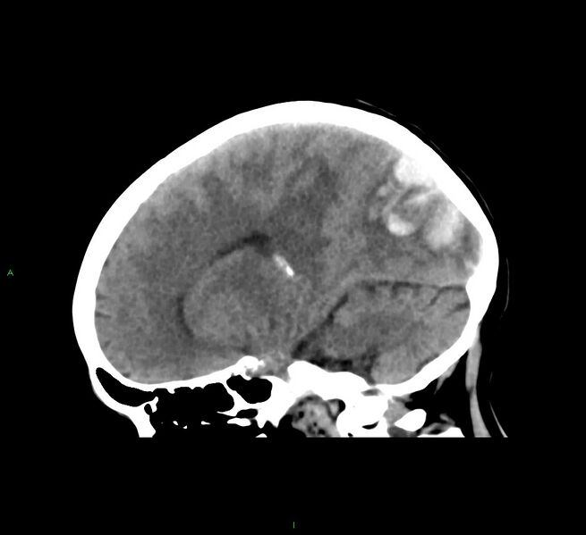 File:Cerebral amyloid angiopathy-associated lobar intracerebral hemorrhage (Radiopaedia 58563-65727 C 24).jpg
