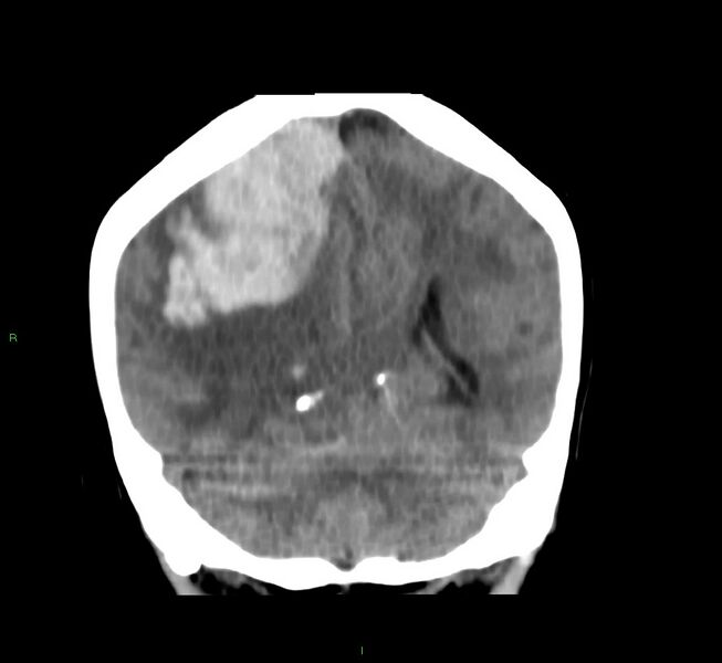 File:Cerebral amyloid angiopathy-associated lobar intracerebral hemorrhage (Radiopaedia 58751-65972 Coronal non-contrast 23).jpg