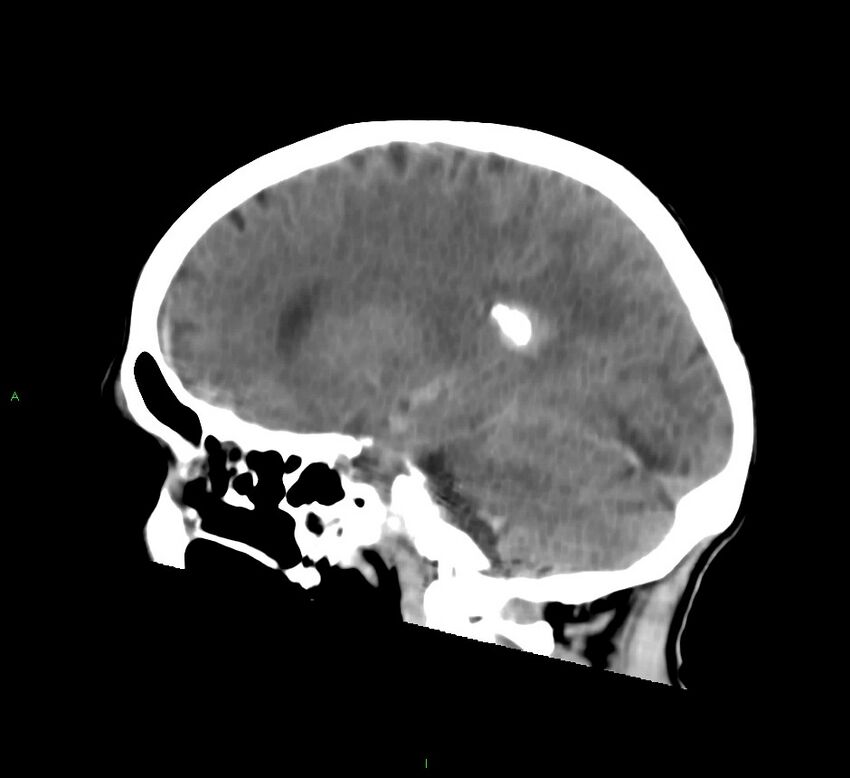 Cerebral amyloid angiopathy-associated lobar intracerebral hemorrhage (Radiopaedia 58758-65980 C 23).jpg