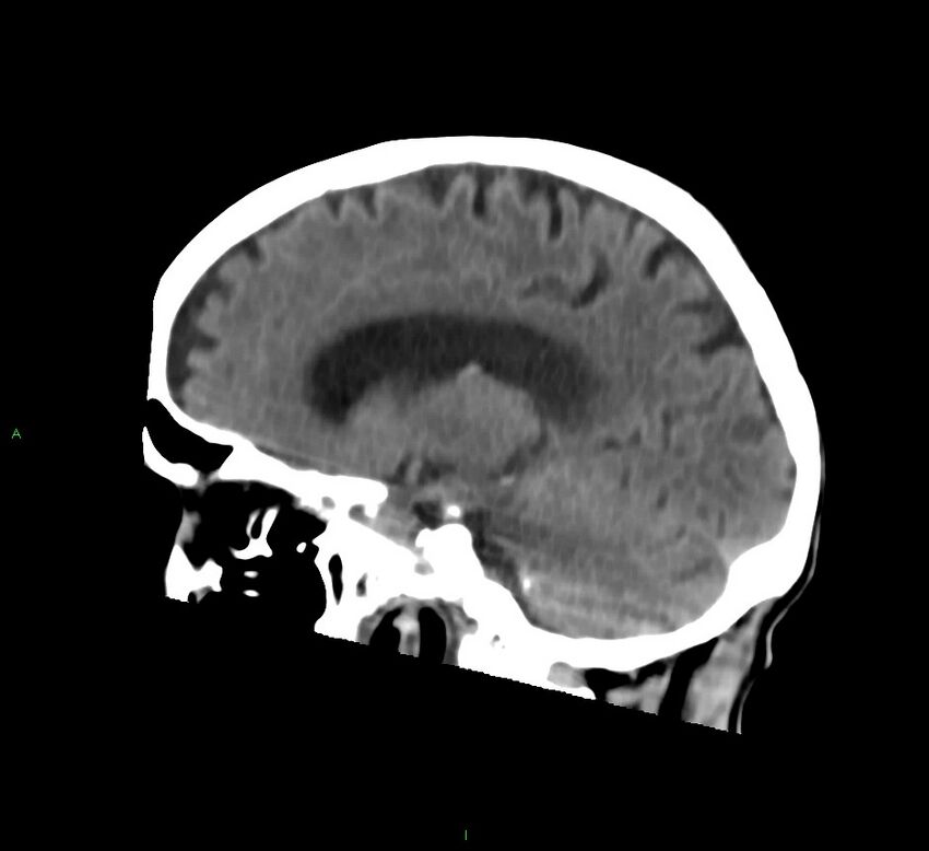 Cerebral amyloid angiopathy-associated lobar intracerebral hemorrhage (Radiopaedia 58758-65980 C 33).jpg