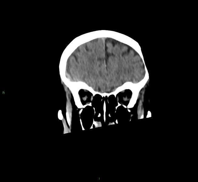 File:Cerebral amyloid angiopathy-associated lobar intracerebral hemorrhage (Radiopaedia 58758-65980 Coronal non-contrast 49).jpg