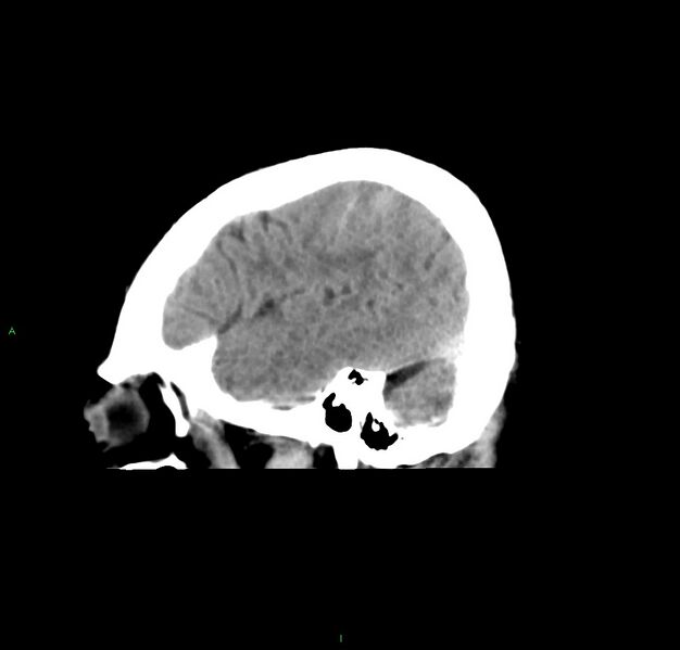 File:Cerebral amyloid angiopathy-associated lobar intracerebral hemorrhage (Radiopaedia 59356-66716 C 13).jpg