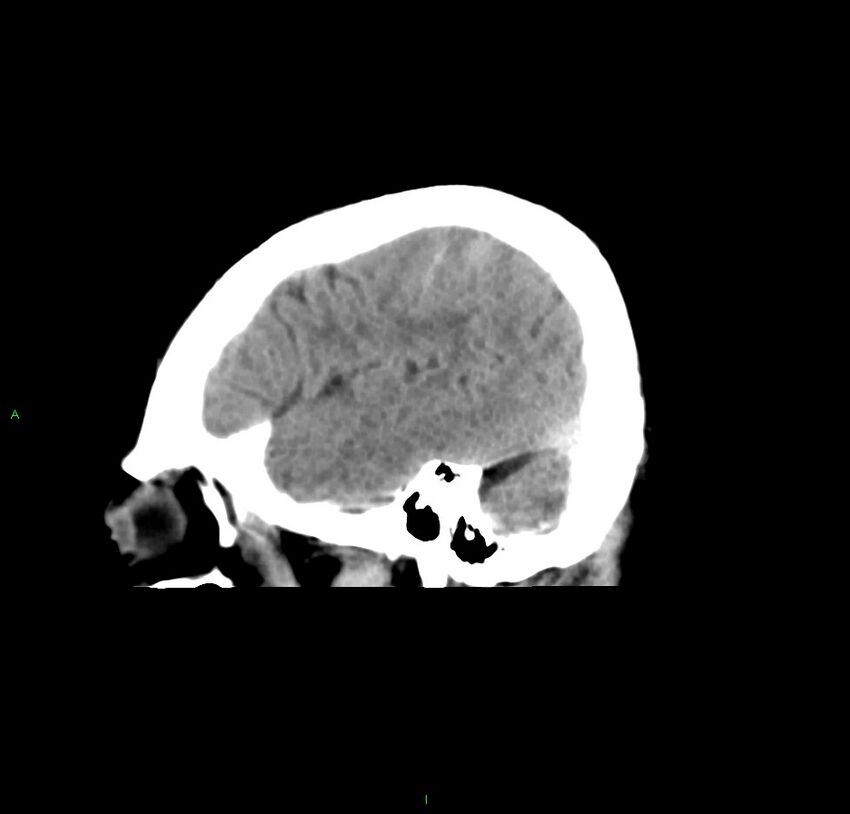 Cerebral amyloid angiopathy-associated lobar intracerebral hemorrhage (Radiopaedia 59356-66716 C 13).jpg