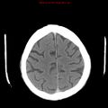 Cerebral and orbital tuberculomas (Radiopaedia 13308-13310 B 23).jpg