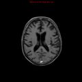 Cerebral and orbital tuberculomas (Radiopaedia 13308-13311 Axial T1 C+ 13).jpg