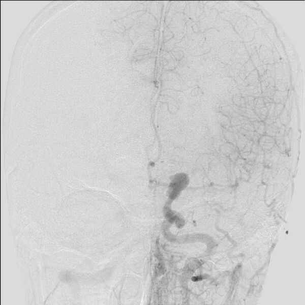 File:Cerebral aneurysm with rupture (Radiopaedia 29933-30458 LT ICA IC 18).jpg