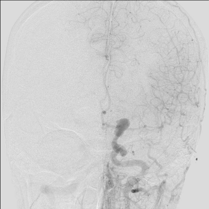 Cerebral aneurysm with rupture (Radiopaedia 29933-30458 LT ICA IC 18).jpg