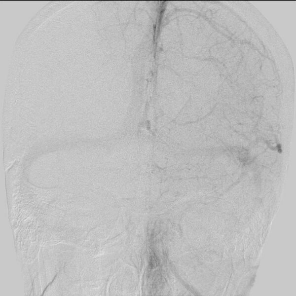 File:Cerebral aneurysm with rupture (Radiopaedia 29933-30458 LT ICA IC 22).jpg
