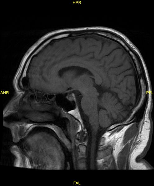 File:Cerebral autosomal dominant arteriopathy with subcortical infarcts and leukoencephalopathy (CADASIL) (Radiopaedia 86108-102054 Sagittal T1 13).jpg