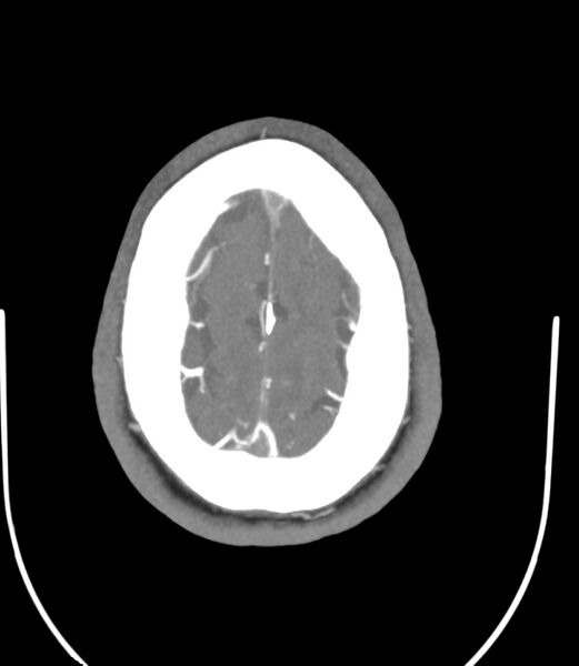 File:Cerebral dural venous sinus thrombosis (Radiopaedia 86514-102576 A 84).jpg