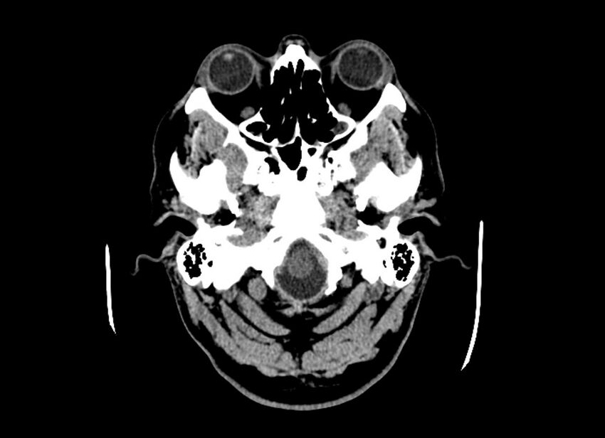 Cerebral edema (Radiopaedia 82519-96661 Axial non-contrast 49).jpg