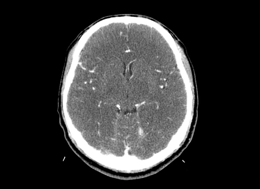 Cerebral edema (Radiopaedia 82519-96661 B 32).jpg