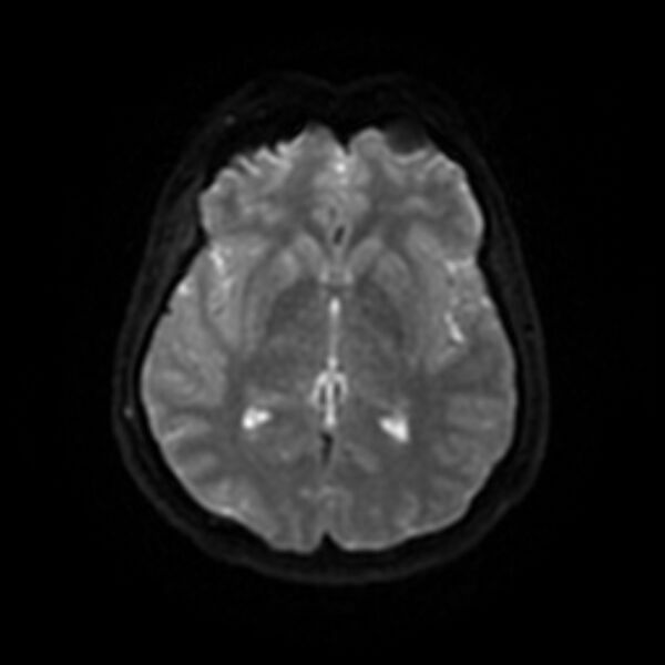 File:Cerebral fat embolism (Radiopaedia 37510-39363 Axial DWI 37).jpg