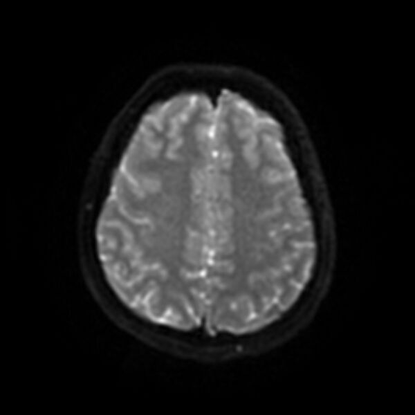 File:Cerebral fat embolism (Radiopaedia 37510-39363 Axial DWI 43).jpg