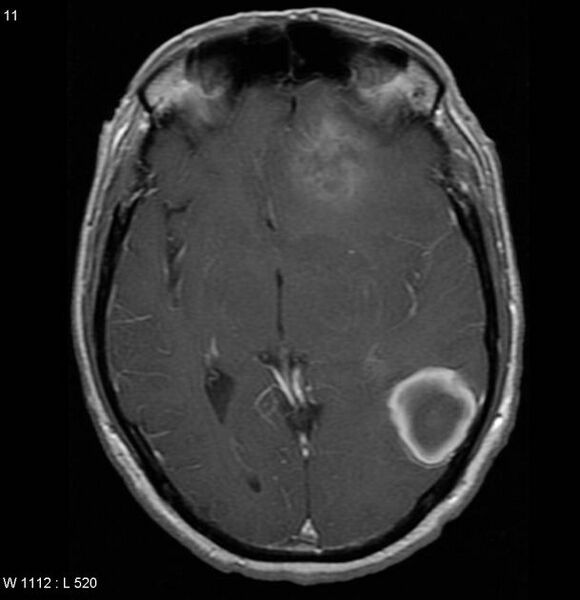 File:Cerebral metastases - renal cell carcinoma (Radiopaedia 5510-7246 Axial T1 C+ 6).jpg