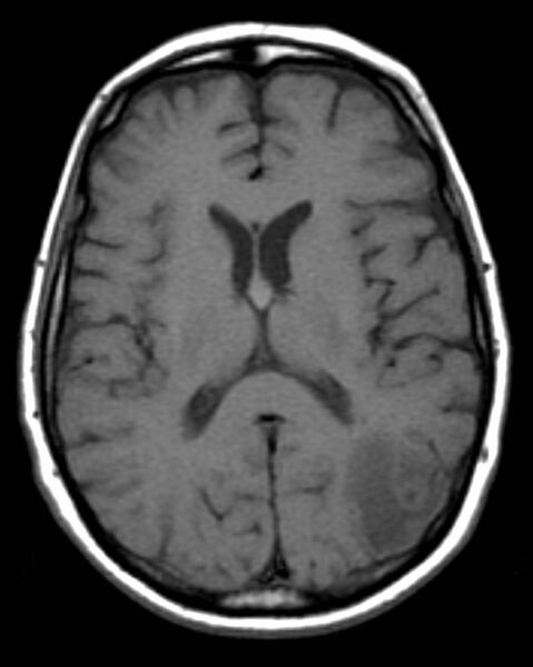 File:Cerebral metastasis - Bull's eye sign (Radiopaedia 2588-6283 Axial T1 1).jpg