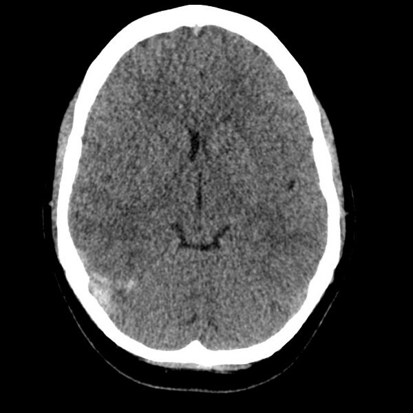 File:Cerebral venous sinus thrombosis (Radiopaedia 59224-66551 Axial non-contrast 6).jpg