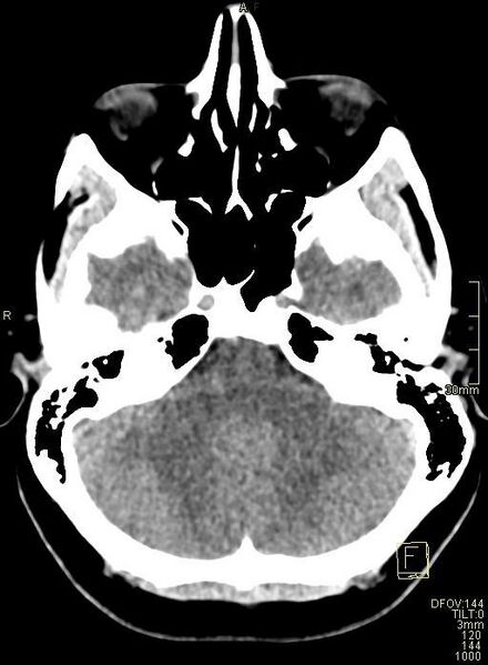 File:Cerebral venous sinus thrombosis (Radiopaedia 91329-108965 Axial non-contrast 12).jpg