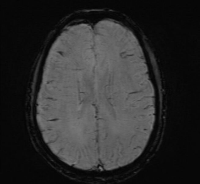 File:Cerebral venous thrombosis (Radiopaedia 71207-81504 Axial SWI 34).jpg