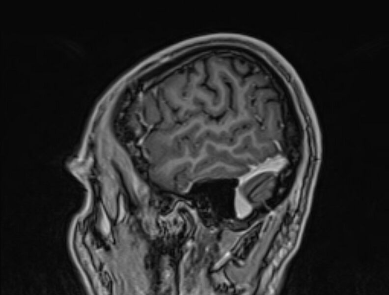 File:Cerebral venous thrombosis (Radiopaedia 71207-81504 Sagittal T1 C+ 6).jpg