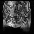 Cervical carcinoma (Radiopaedia 78847-91705 Coronal T1 4).jpg