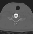 Cervical disc replacement (Radiopaedia 37383-39205 Axial bone window 11).png
