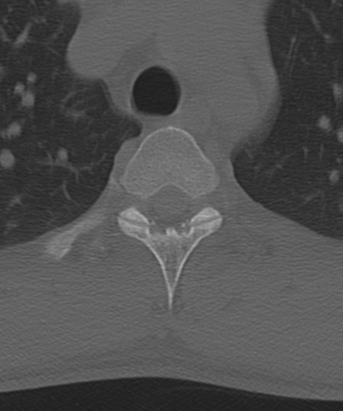 File:Cervical intercalary bone (Radiopaedia 35211-36748 Axial bone window 76).png