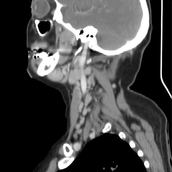 File:Cervical lymphadenopathy- cause unknown (Radiopaedia 22420-22457 D 10).jpg