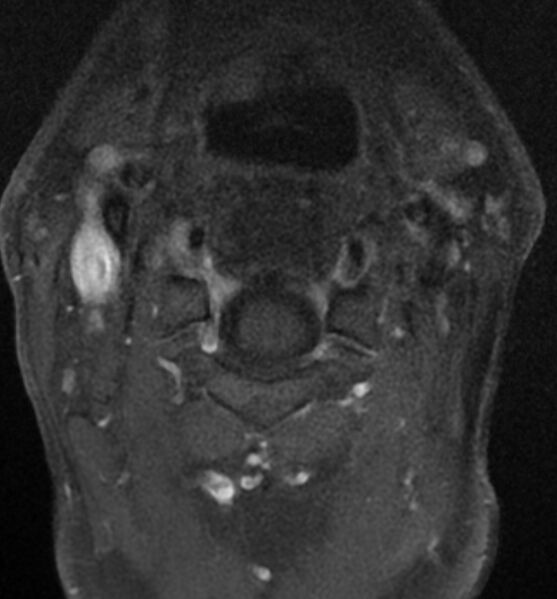 File:Cervical spondylodiscitis (Radiopaedia 81362-95110 Axial T1 C+ fat sat 2).jpg