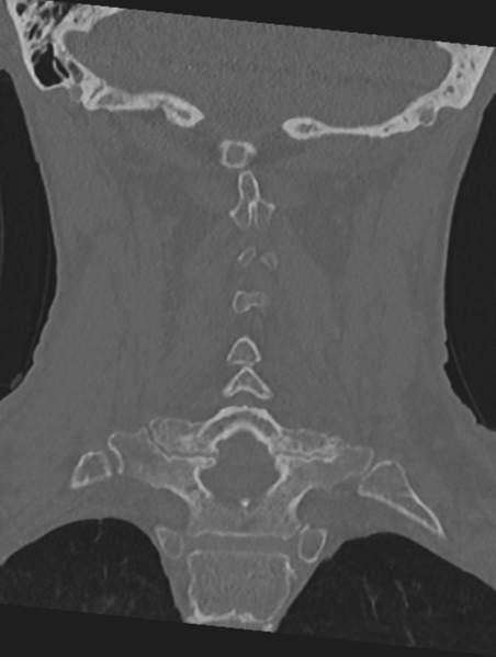 File:Cervical spondylolysis (Radiopaedia 49616-54811 Coronal bone window 34).png
