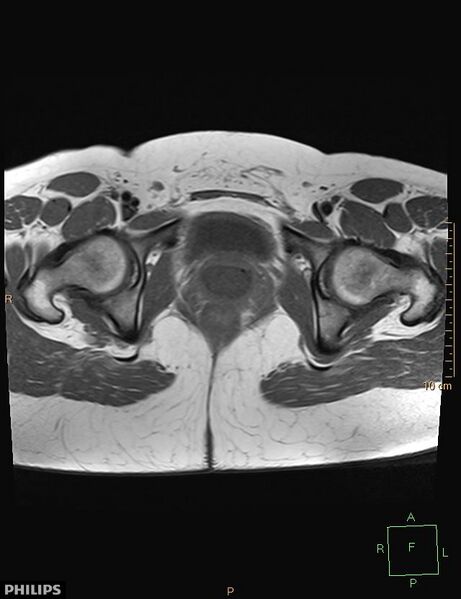 File:Cesarian scar endometriosis (Radiopaedia 68495-78066 Axial T1 21).jpg