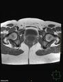 Cesarian scar endometriosis (Radiopaedia 68495-78066 Axial T1 21).jpg