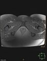 Cesarian scar endometriosis (Radiopaedia 68495-78066 Axial T1 C+ fat sat 26).jpg
